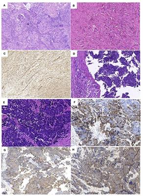 Large cell neuroendocrine carcinoma of the cervix: a case report